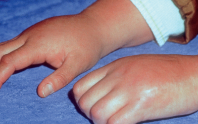 Jakie zmiany w mózgu obserwujemy przy kompleksowym zespole bólu regionalnego? Przegląd badań