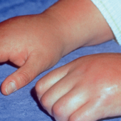 Jakie zmiany w mózgu obserwujemy przy kompleksowym zespole bólu regionalnego? Przegląd badań