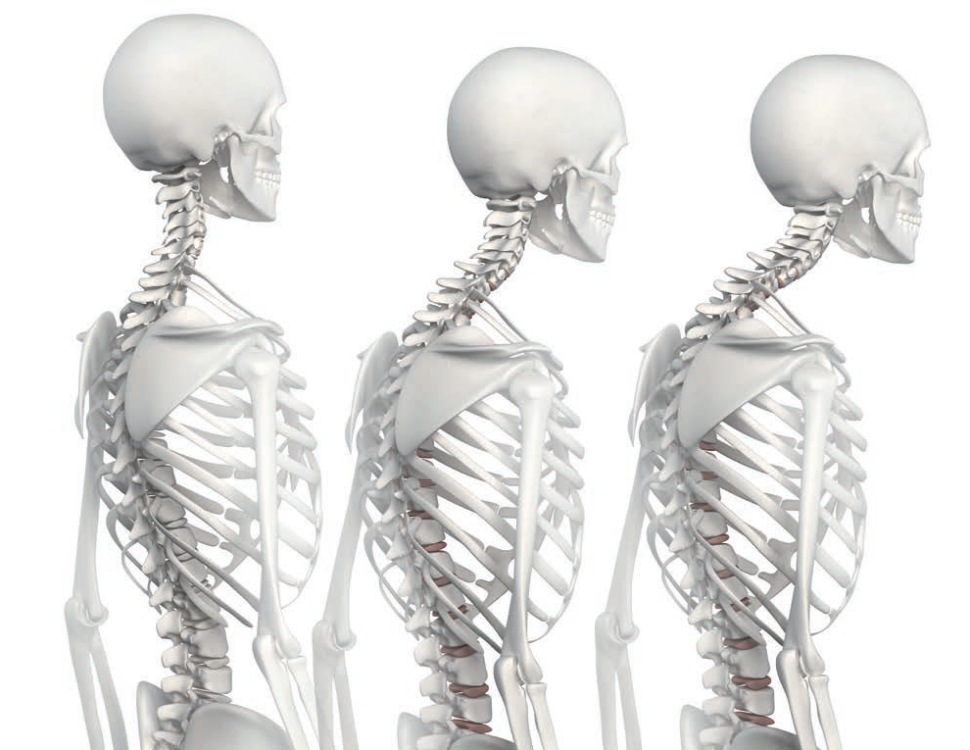 Hiperkifoza i protrakcja głowy – przeciążenie przejścia szyjno-piersiowego