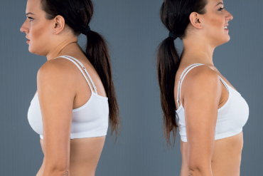 Terapia manualna skolioz u dorosłych