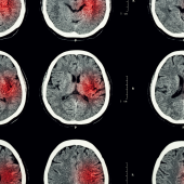 Rehabilitacja po udarze. Czy kompensacja jest jedynym rozwiązaniem?