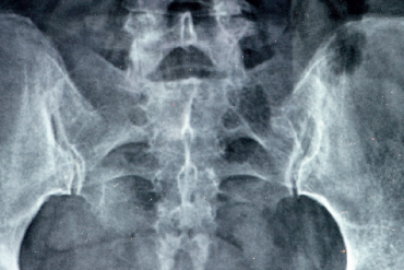 Terapia manualna stawu krzyżowo-biodrowego