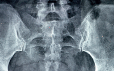 Terapia manualna stawu krzyżowo-biodrowego