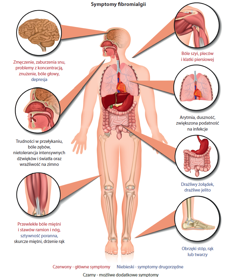 Grafika przedstawiająca symptomy fibromialgii
