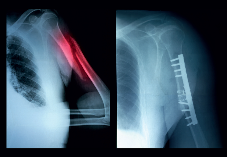 Przykładowe złamanie części proksymalnej kości ramiennej wraz z jego zaopatrzeniem chirurgicznym