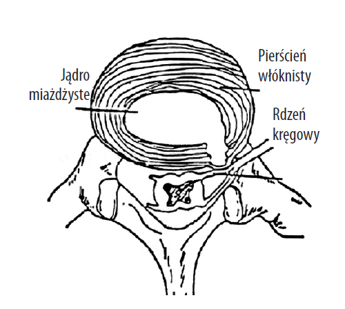 Przepuklina jądrowa krążka międzykręgowego; przykład przepukliny tylno-bocznej