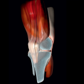 Zespół bólowy przedniego aspektu kolana