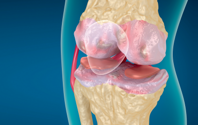 Terapia manualna w artrozie kolana