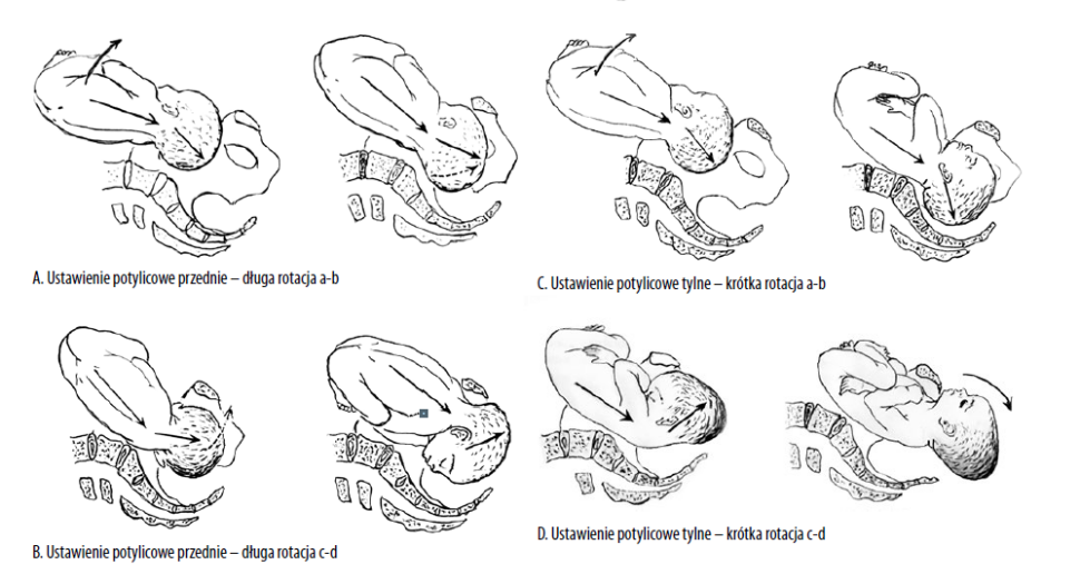 Grafika przedstawiająca ustawienia płodu i ich wpływ na przebieg porodu w kontekście obciążenia struktur istotnych dla procesu ssania