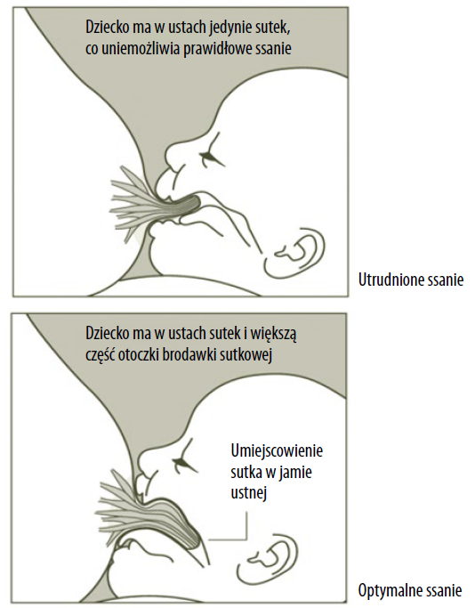 Grafika przedstawiająca przystawianie dziecka do piersi przy korzystnych i niekorzystnych warunki ssania