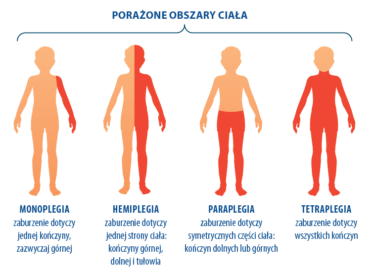 Schemat przedstawiający porażone obszary ciała u dzieci z porażeniem mózgowym