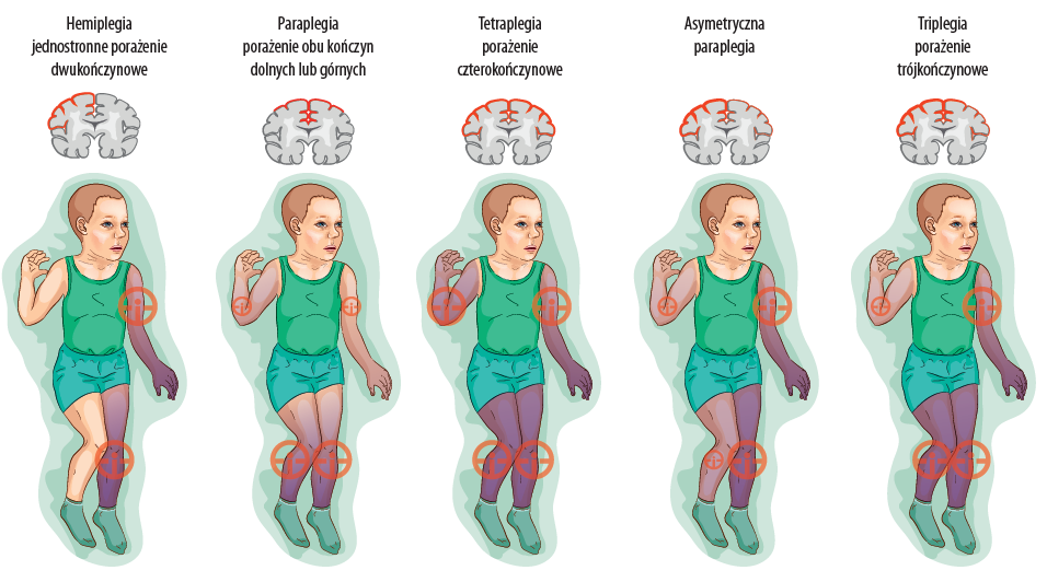 Schemat przedstawiający rodzaje uszkodzenia mózgu u dzieci z porażeniem mózgowym