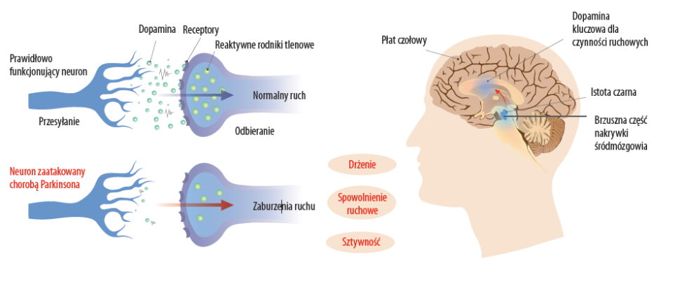 Infografika przedstawiająca zanik komórek dopaminergicznych w rozwoju choroby Parkinsona