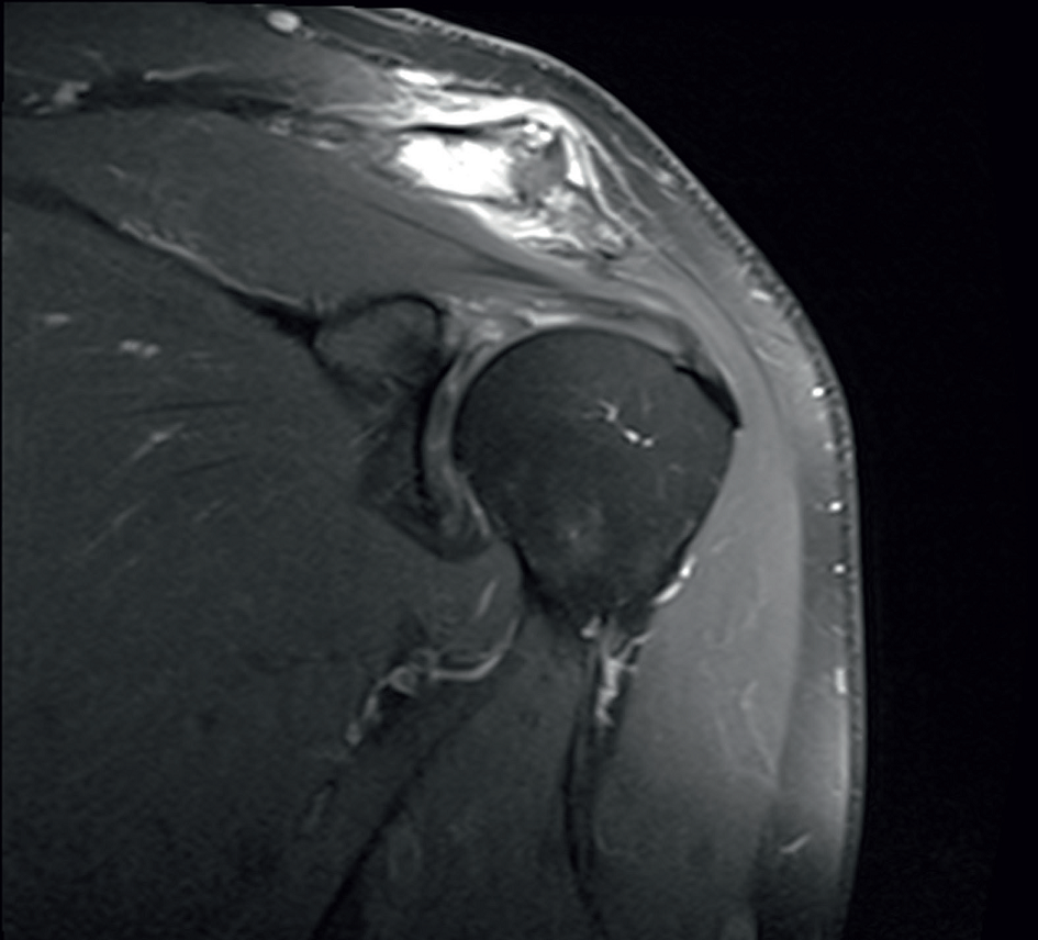 Obrzęk i osteoliza bocznego końca obojczyka w obrazie rezonansu magnetycznego