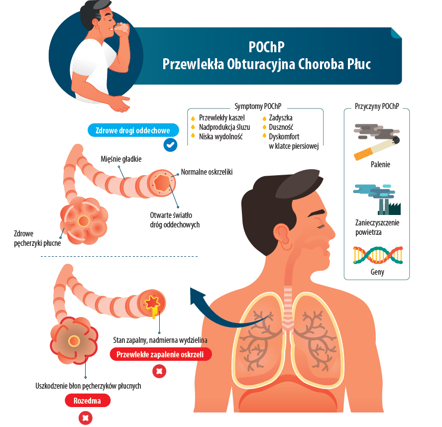 Najważniejsze informacje o przewlekłej obturacyjnej chorobie płuc