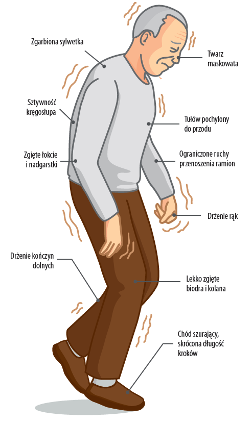 Główne objawy posturalne w zaawansowanym stadium choroby Parkinsona