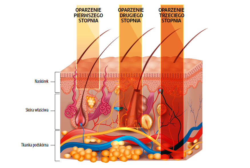 Grafika przedstawiająca różne stopnie poparzenia skóry