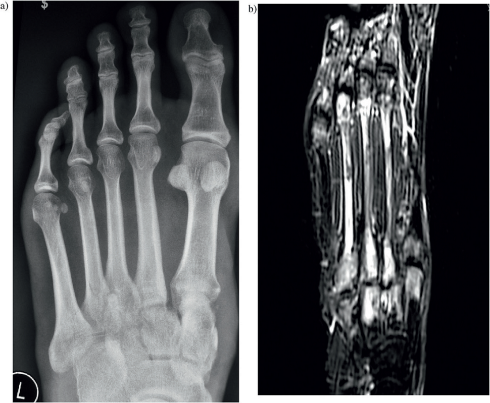 Złamanie stawu Lisfranca z bocznym zwichnięciem drugiej kości śródstopia w stosunku do kości klinowatej pośredniej i rezonans magnetyczny uszkodzonej stopy pokazujący stłuczenie wszystkich okolicznych kości