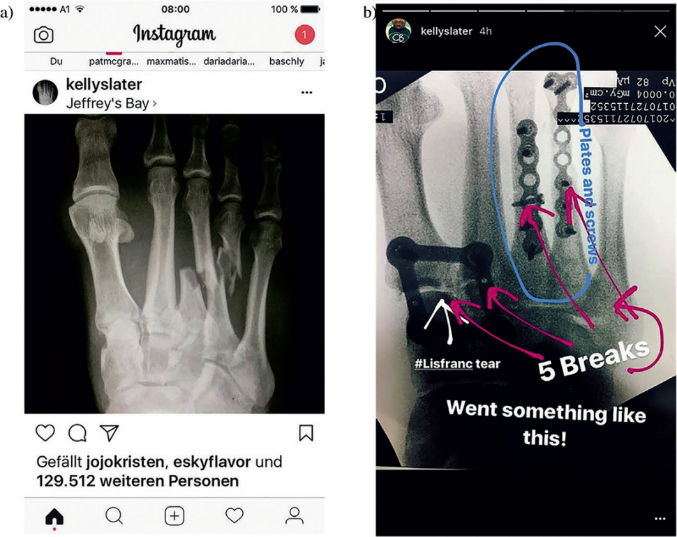 Złamanie śródstopia