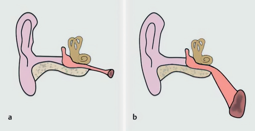 Trąbka słuchowa u niemowląt (a) i dorosłych (b).