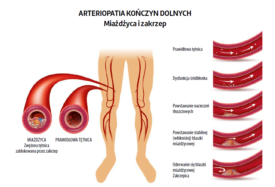 Grafika przedstawiająca arteriopatię kończyn dolnych