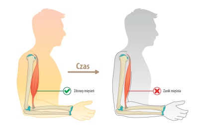 Fizjoterapia w dystrofii mięśniowej