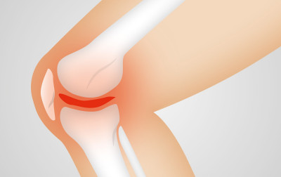 Bezpieczeństwo zabiegu endoprotezoplastyki kolana