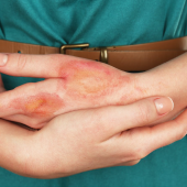 Fizjoterapia pacjentów po oparzeniach