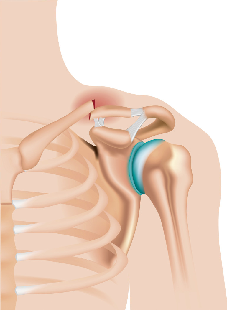 bark, uszkodzenie, pęknięcie