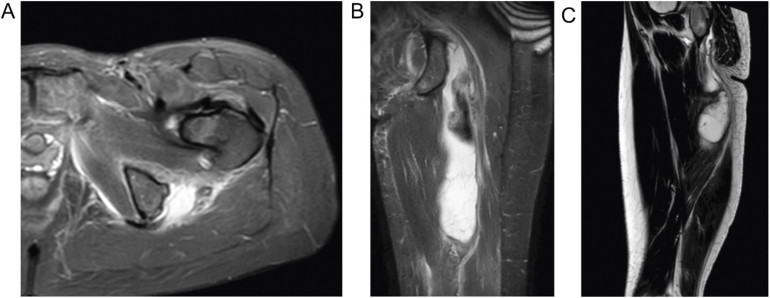 Ryc. 7. Całkowite zerwanie (PH) na poziomie lewego guza kulszowego (stopień IV). A) MRI pokazuje zatarcie struktury ścięgna z wytworzeniem „bulwy”. Nadmierna akumulacja płynu wskazuje na przerwanie ścięgna na kości. Przekrój czołowy (B) oraz strzałkowy (C) wykazują lukę między proksymalną częścią ścięgna a bulwą kulszową. Dodatkowo, pęknięcie domięśniowe z towarzyszącym rozległym tworzeniem krwiaka jest pokazane jako obszary hiperintensywne.