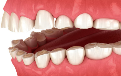 Program siedmiu etapów dla pacjentów z bruksizmem