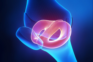 Zabiegi na menisku nie zwiększają opóźnionej rekonstrukcji ACL i rehabilitacji: wyniki randomizowanego badania kontrolowanego